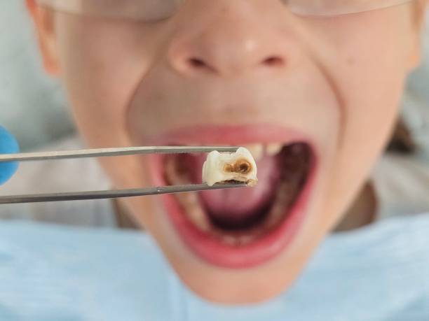 Best Emergency Treatment for Oral Infections in Mercerville, NJ